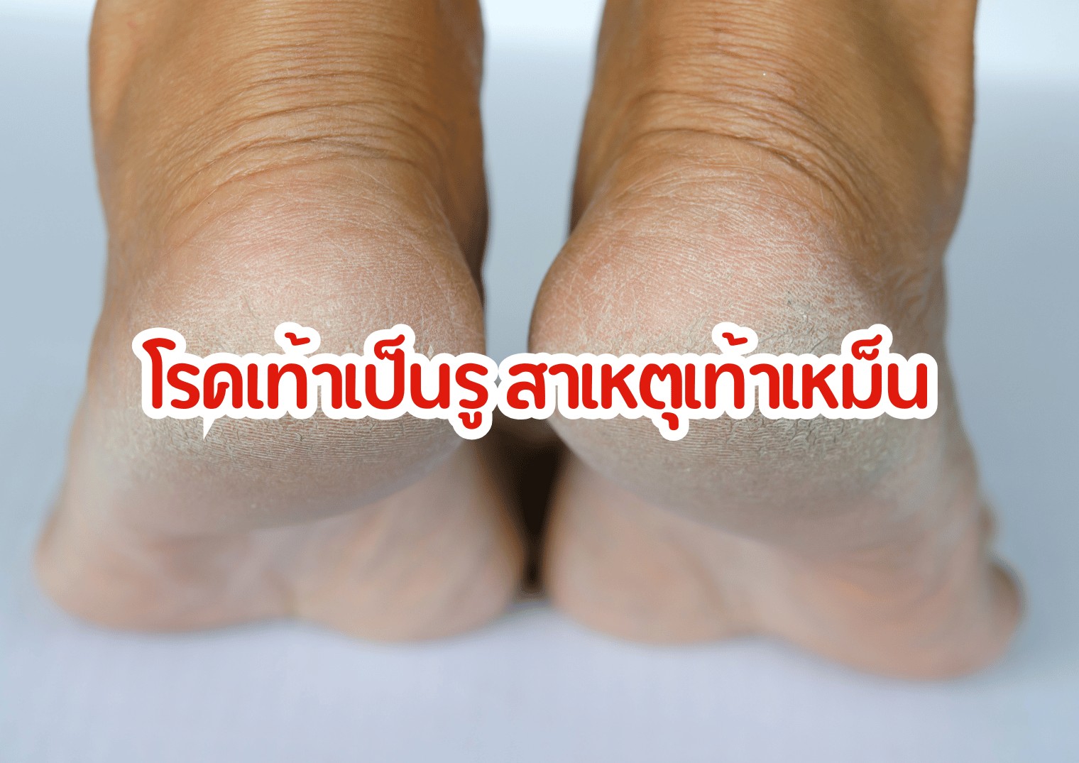 โรคเท้าเป็นรู สาเหตุเท้าเหม็น