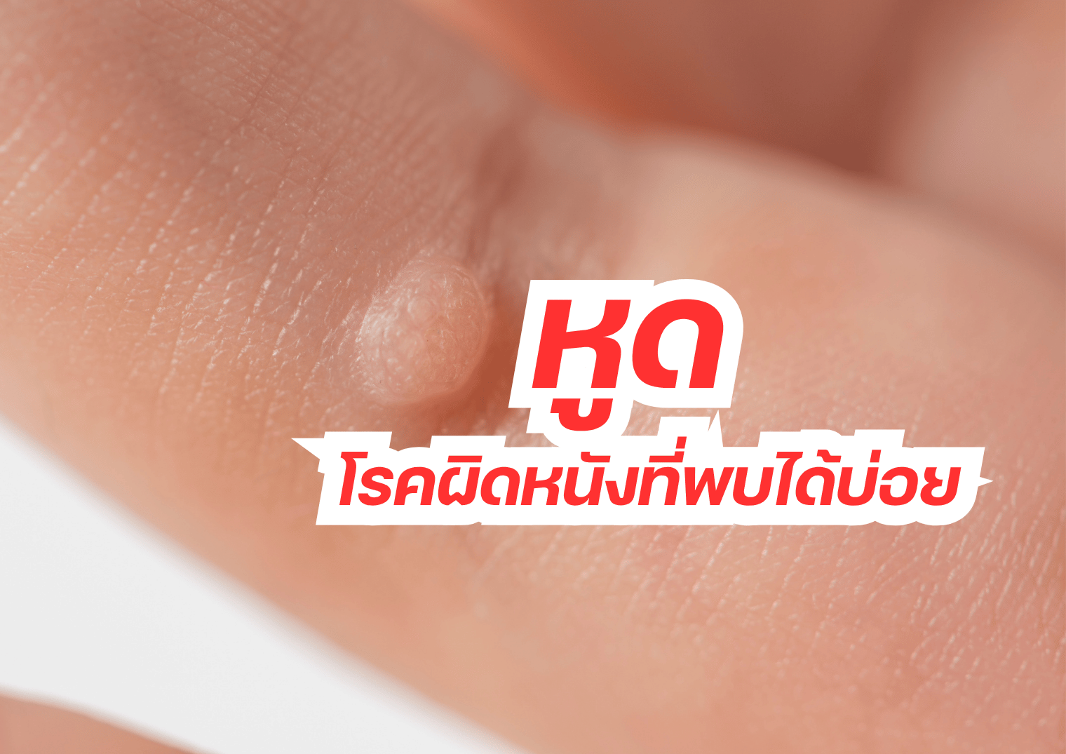 หูด โรงผิวหนังที่พบได้บ่อย